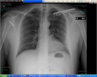 chest xray 041608.jpg